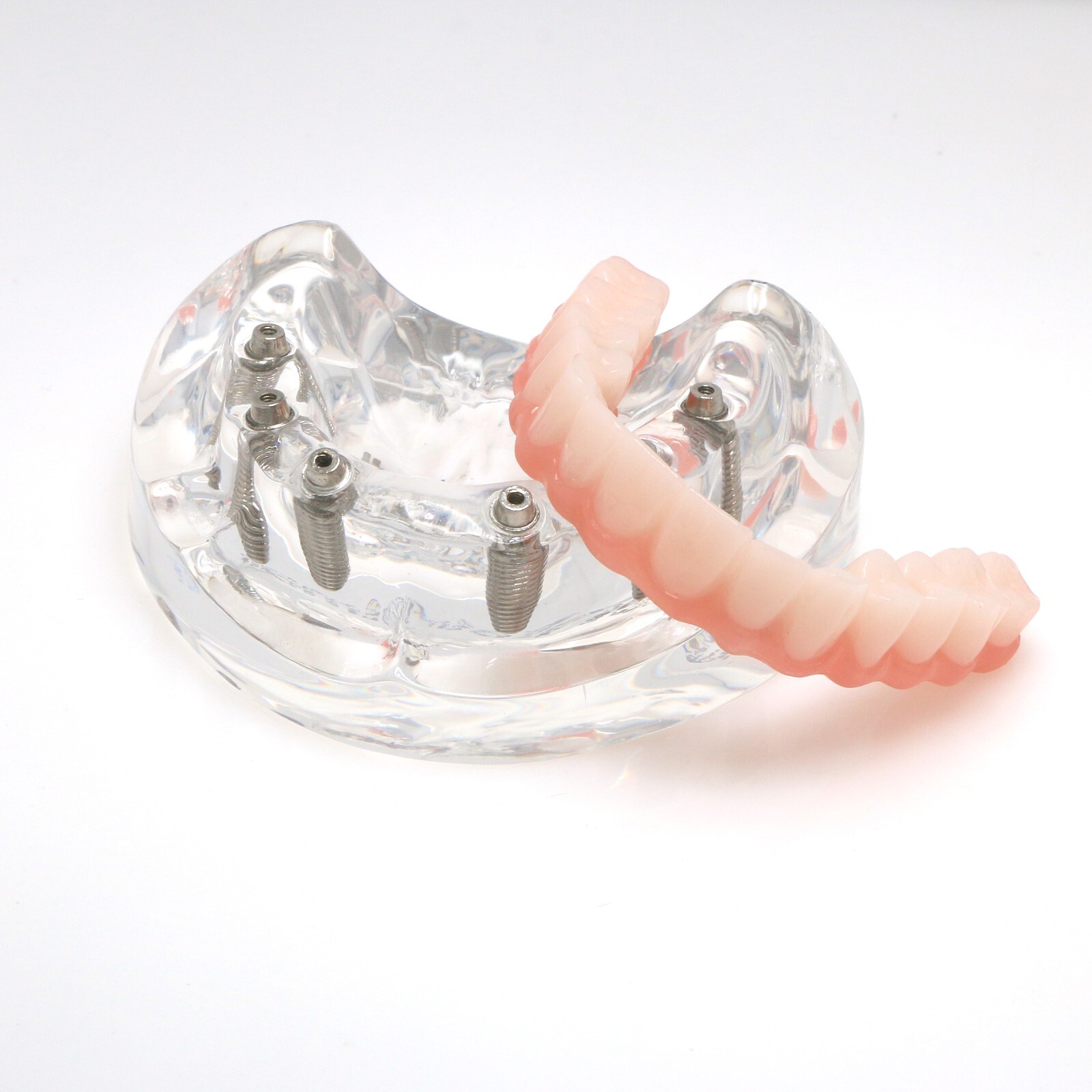 All-on-4/6 Screws Restoration Overdenture Dental Implant Model Upper/Lower Jaw