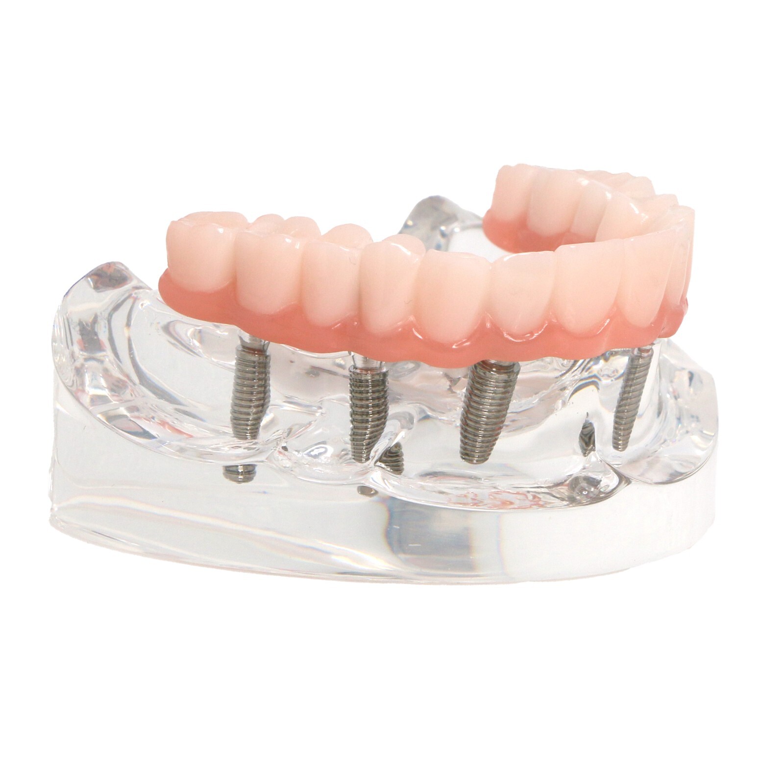 All-on-4/6 Screws Restoration Overdenture Dental Implant Model Upper/Lower Jaw