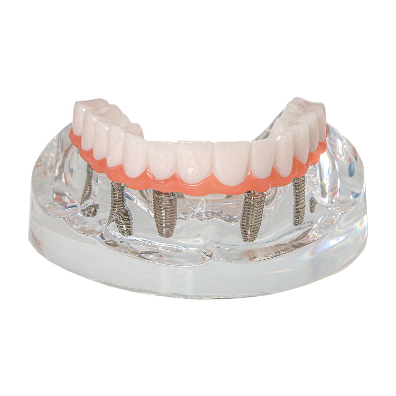 All-on-4/6 Screws Restoration Overdenture Dental Implant Model Upper/Lower Jaw