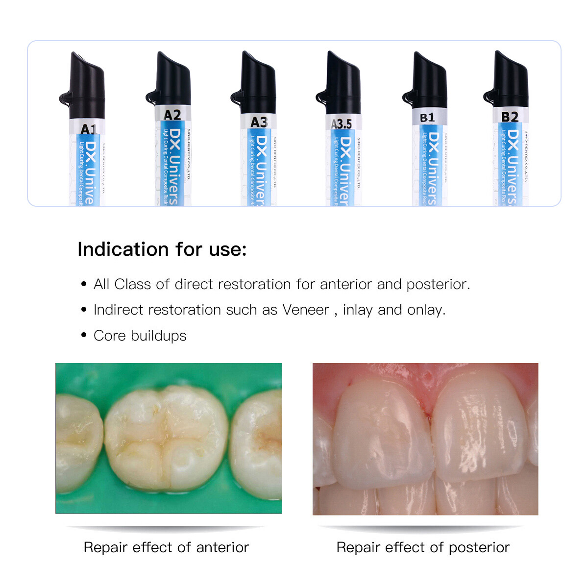 Dental Light Cure Nano Hybrid Composite Resins Dentex Universal A1 A2 A3 A3.5 US